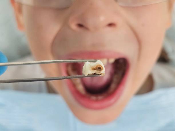 Best Emergency Tooth Extraction in Nixon, PA